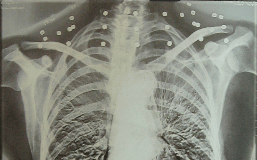 皇冠信用盘可以占几成_“老先生皇冠信用盘可以占几成，您把项链取下来再做CT”