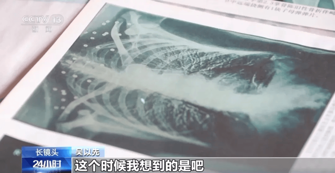 皇冠信用盘可以占几成_“老先生皇冠信用盘可以占几成，您把项链取下来再做CT”